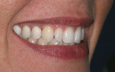 Dental implants case after