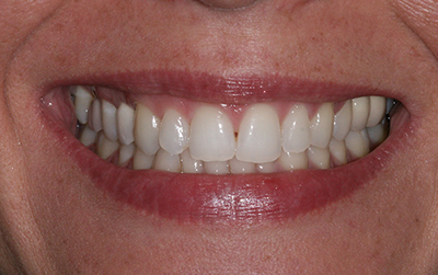 Dental implants case after