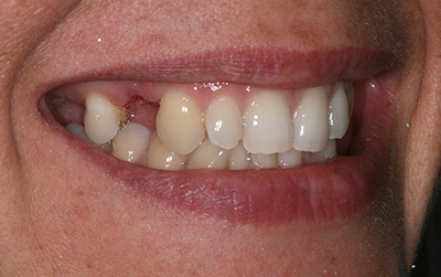 Dental implants case before