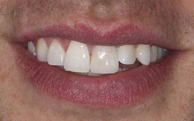 Whitening & Veneers case before