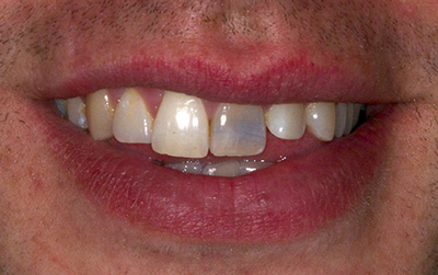 Whitening & Veneers case before