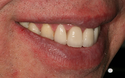 Full mouth reconstruction after