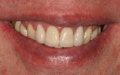 Full mouth reconstruction after